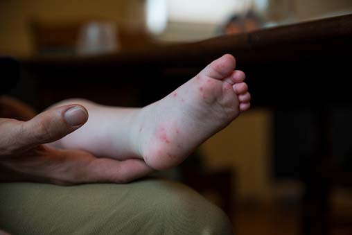 blister on baby's feet=